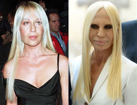 donatella versace diana|donatella versace before and after surgery.